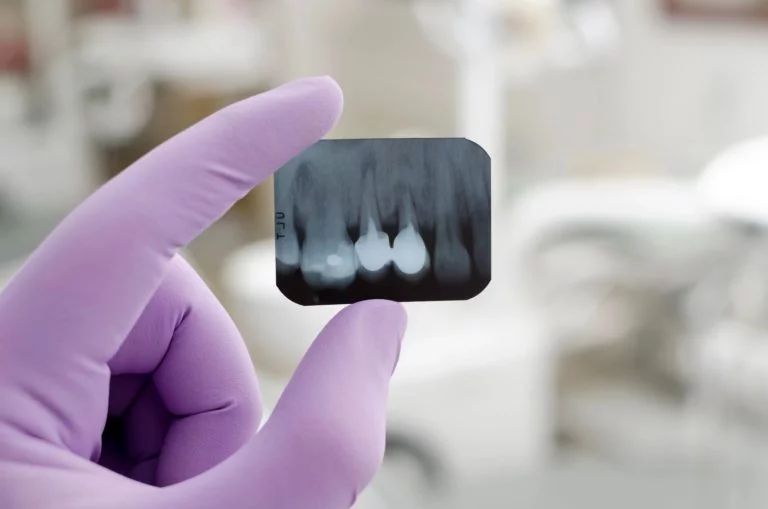 teeth xrays